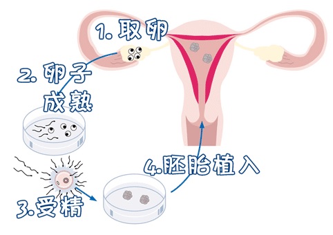 三代试管供卵生男孩